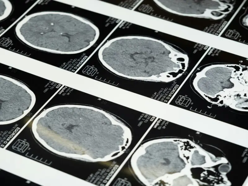 Neuralink's Second Transplant